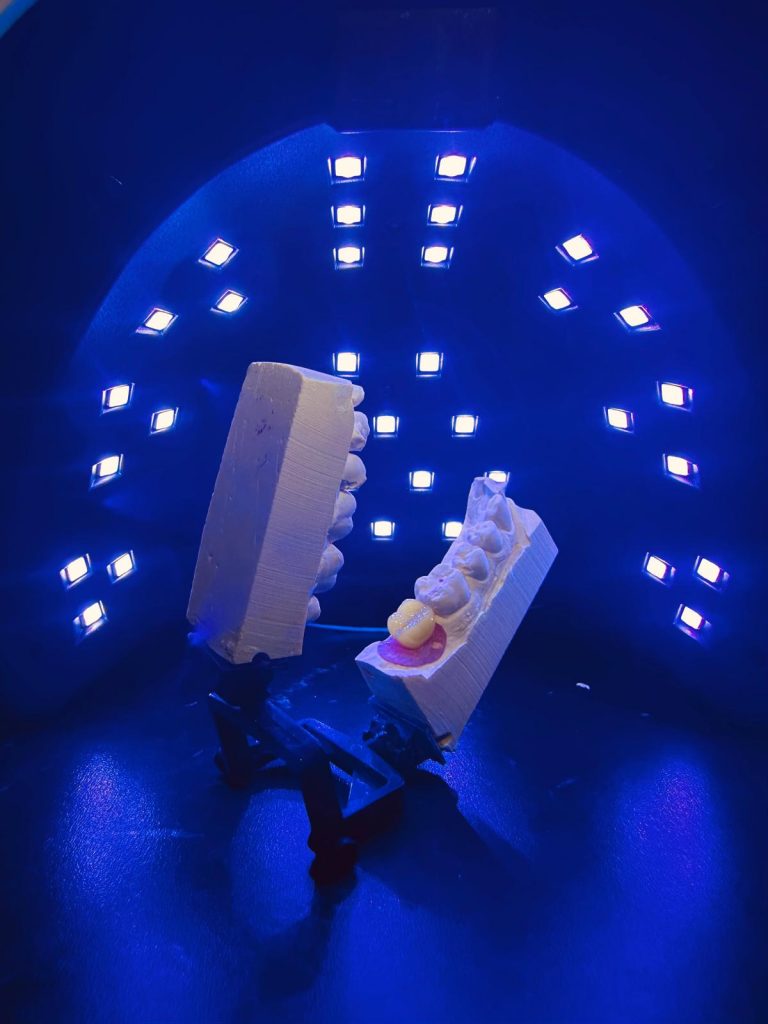 Prothèse unitaire sur implant
