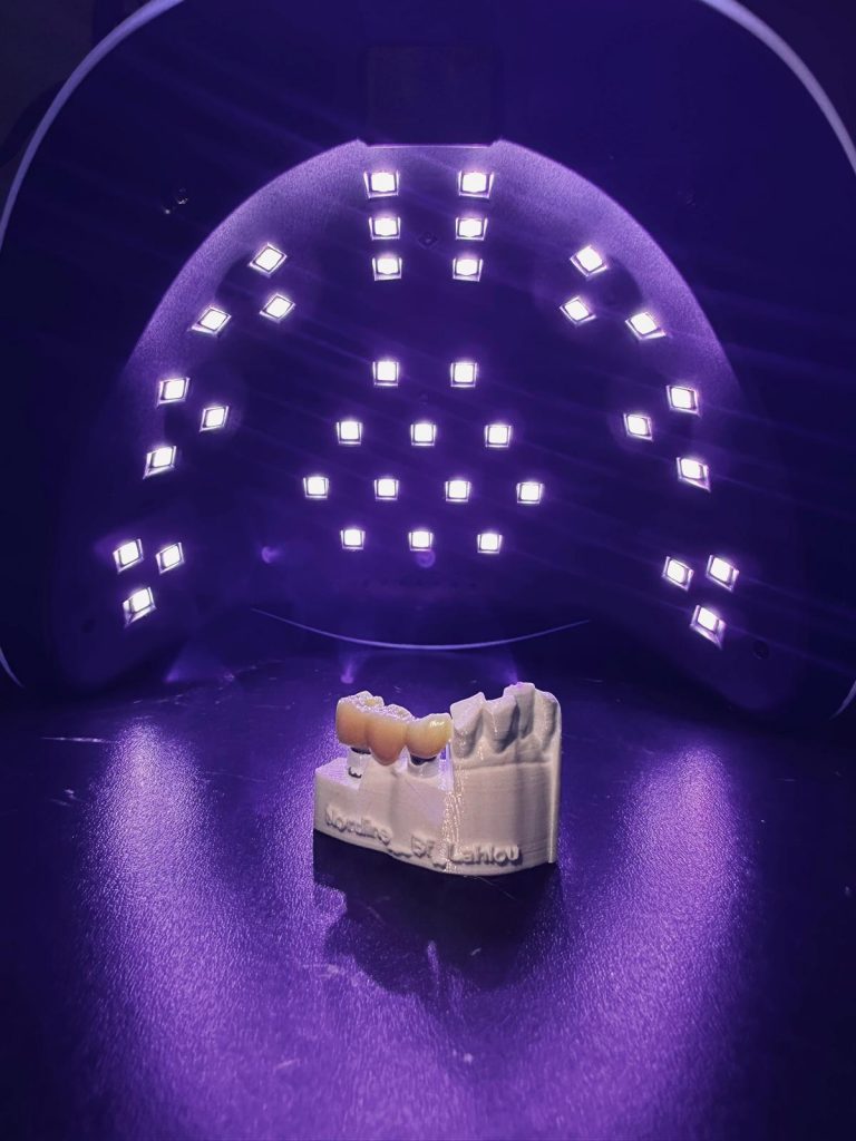 Bridge sur implants sur un modèle 3D